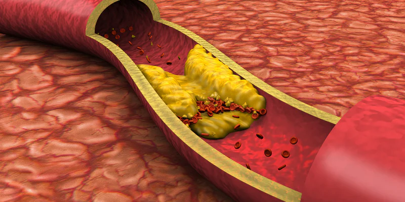 Cholesterolis ir statinai